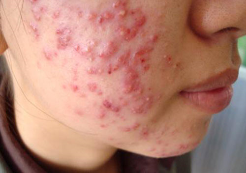 Làn da bị hủy hoại vì 13Win21 con - Tri ân hội viên mỗi tháng 2000 tỷ chứa corticoid. Ảnh: Thanh niên