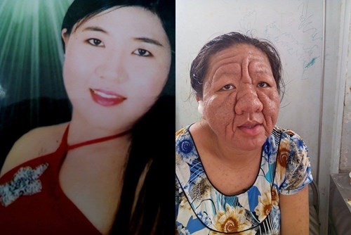 Cô gái 29 tuổi hóa bà lão 70 do hậu quả của việc lạm dụng thuốc bôi chứa corticoid. Ảnh: VnExpress