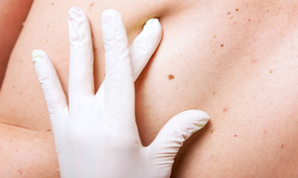 Hầu hết c&aacute;c nốt ruồi l&agrave; v&ocirc; hại, nhưng ch&uacute;ng cũng l&agrave; dấu hiệu cảnh b&aacute;o một loại ung thư da. Ảnh: Thinstock.