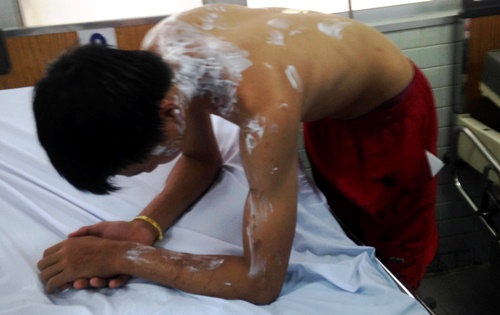 Nam công nhân làm việc trong công trình gần chợ Kim Biên bị axit văng trúng. Nam công nhân làm việc trong công trình gần chợ Kim Biên bị axit văng trúng.