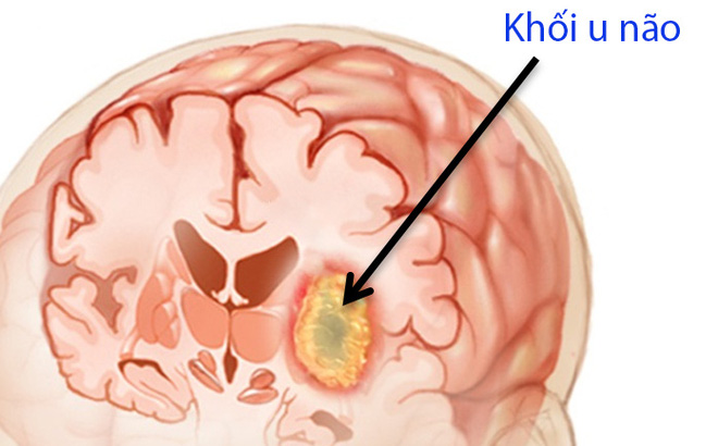 C&aacute;c tế b&agrave;o ung thư ph&aacute;t triển trong n&atilde;o g&acirc;y ảnh hưởng đến hoạt động của n&atilde;o bộ. Ảnh minh họa