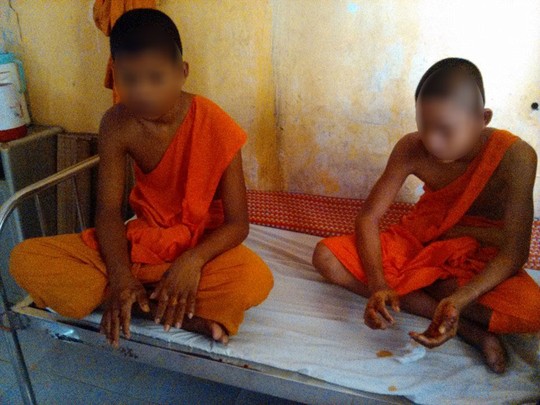 2 chú tiểu bị ép nhúng tay vào chảo dầu sôi để chứng minh không ăn cắp tiền của nhà chùa 2 chú tiểu bị ép nhúng tay vào chảo dầu sôi để chứng minh không ăn cắp tiền của nhà chùa