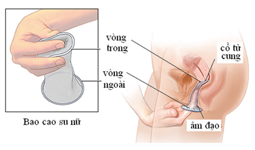 C&aacute;ch d&ugrave;ng bao cao su cho nữ. Ảnh: Bệnh viện Từ Dũ