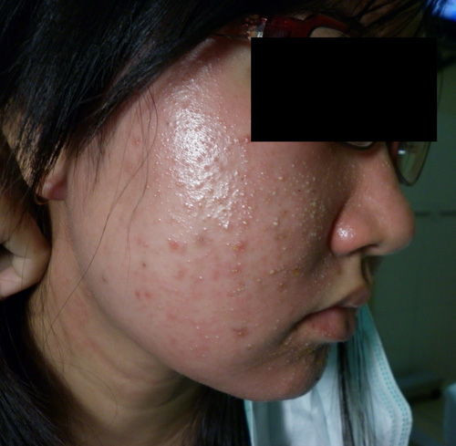 Da mặt h&oacute;a da c&oacute;c v&igrave; d&ugrave;ng kem trắng da &lsquo;si&ecirc;u tốc&rsquo;