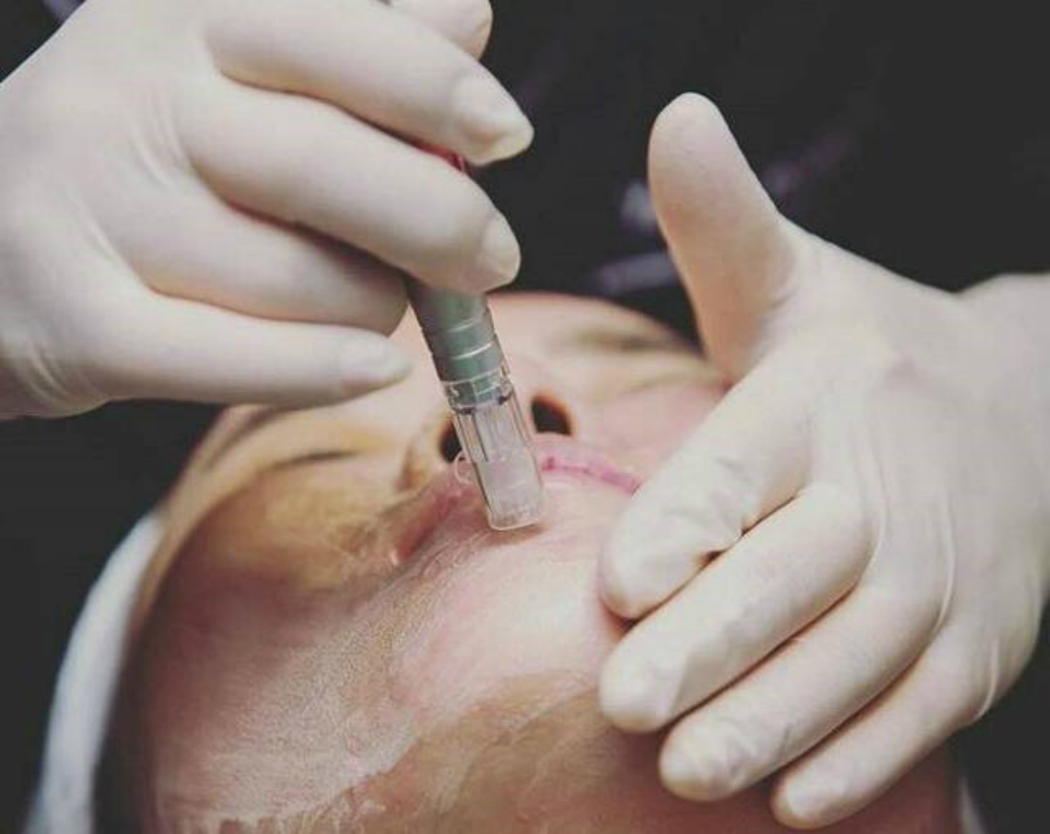 Coi chừng &ocirc;m hận v&igrave; cấy phấn v&agrave;o da