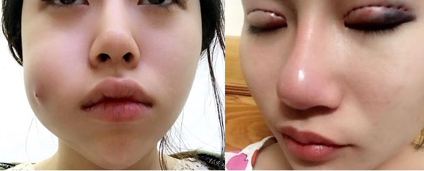 Mất xinh v&igrave;&hellip; dịch vụ thẩm mỹ cắt m&iacute;, phun m&ocirc;i &lsquo;vườn&rsquo;