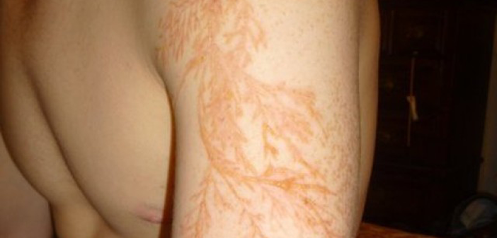 H&igrave;nh Lichtenberg xuất hiện l&agrave; một hiện tượng b&iacute; ẩn sau khi bị s&eacute;t đ&aacute;nh