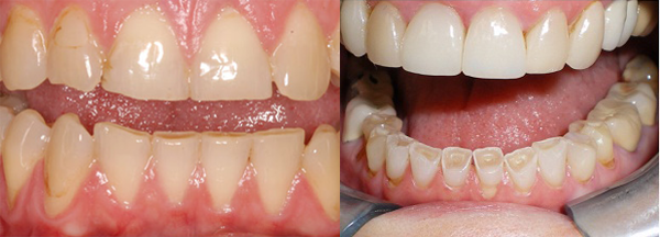 Hiện tượng b&iacute; ẩn nghiến răng khi ngủ c&oacute; thể g&acirc;y n&ecirc;n nhiều vấn đề về răng miệng