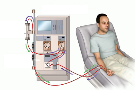 Quy tr&igrave;nh chạy thận nh&acirc;n tạo diễn ra như thế n&agrave;o?