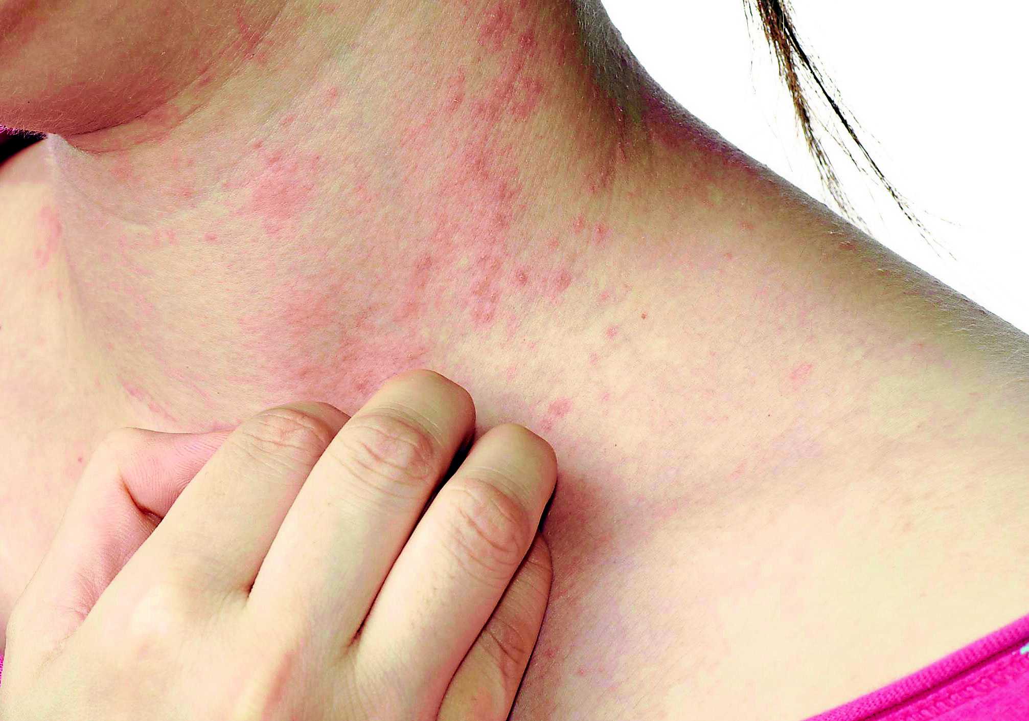 Ngứa da nổi mề đay l&agrave; do nhiễm giun s&aacute;n?