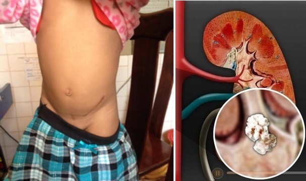 Mẹ khiến con mới 4 tuổi đ&atilde; sỏi thận v&igrave; uống nước cam tươi kiểu n&agrave;y!