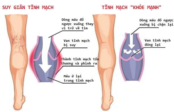 Cẩn trọng với chứng suy gi&atilde;n tĩnh mạch ở d&acirc;n văn ph&ograve;ng g&acirc;y ph&ugrave; ch&acirc;n, đột tử