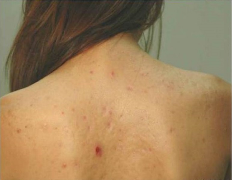 L&yacute; do khiến nổi mụn ở lưng triền mi&ecirc;n v&agrave; tuyệt chi&ecirc;u rẻ tiền dứt điểm mụn