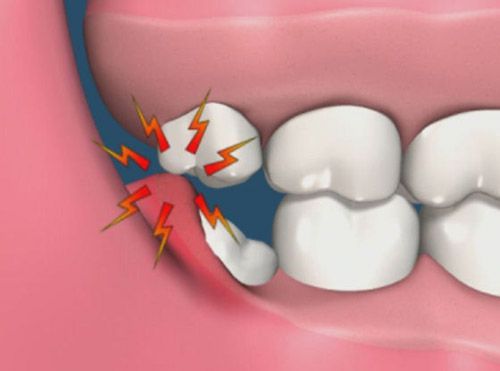 Chuy&ecirc;n gia tiết lộ sự thật kinh ho&agrave;ng: Tử vong v&igrave; chiếc răng kh&ocirc;n, chớ coi thường!