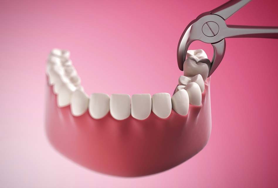 Chuy&ecirc;n gia tiết lộ sự thật kinh ho&agrave;ng: Tử vong v&igrave; chiếc răng kh&ocirc;n, chớ coi thường!