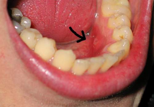 Niềng răng đừng chủ quan với bệnh lo&eacute;t &aacute;p-tơ miệng