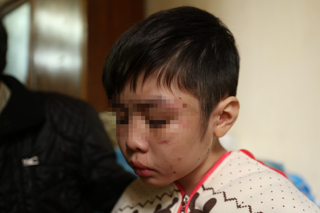 H&agrave;nh tr&igrave;nh bỏ trốn đau đớn khỏi nh&agrave; bố v&agrave; mẹ kế của ch&aacute;u b&eacute; 10 tuổi bị bạo h&agrave;nh