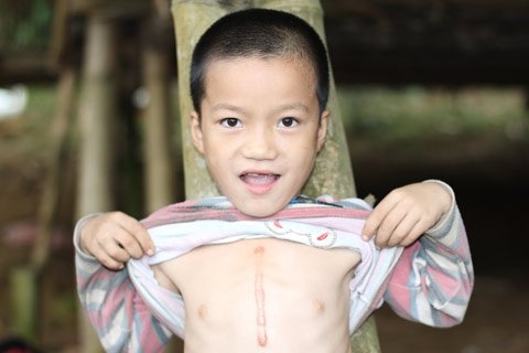 Mổ tim trẻ em