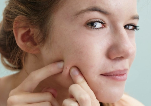 Bỏ t&uacute;i c&aacute;ch chăm s&oacute;c da mụn tại nh&agrave; 'si&ecirc;u hiệu quả'