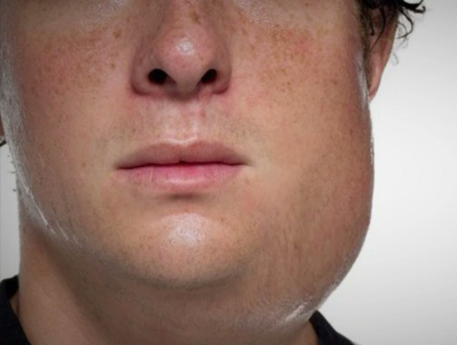 Đ&atilde; mắc Rubella ho&agrave;n to&agrave;n c&oacute; thể mắc bệnh sởi v&agrave; quai bị