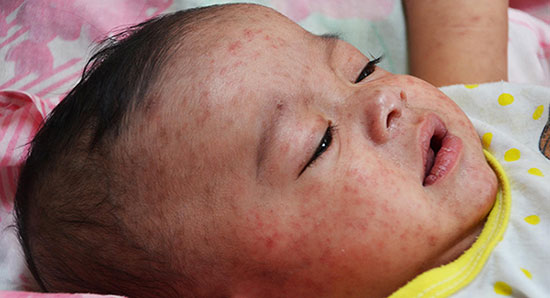 Đ&atilde; mắc Rubella ho&agrave;n to&agrave;n c&oacute; thể mắc bệnh sởi v&agrave; quai bị