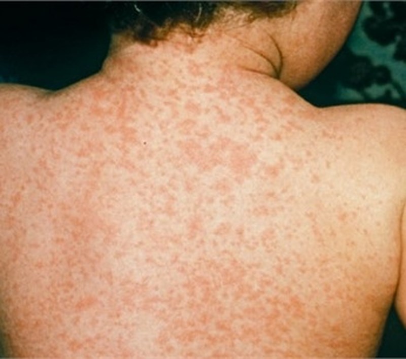 Đ&atilde; mắc Rubella ho&agrave;n to&agrave;n c&oacute; thể mắc bệnh sởi v&agrave; quai bị