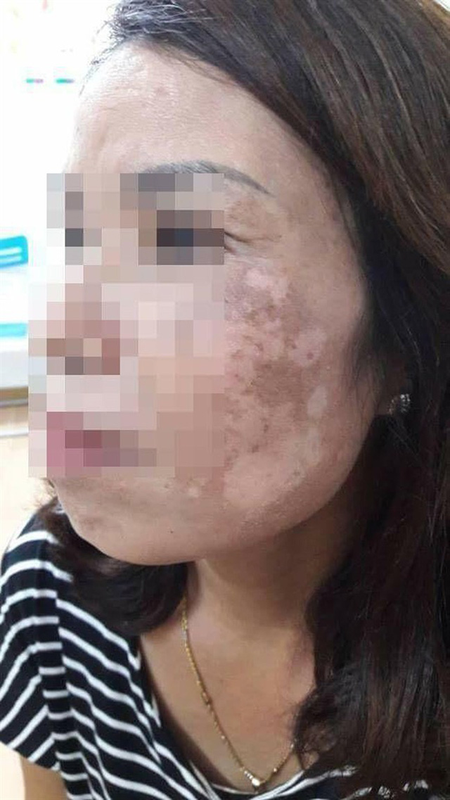 D&ugrave;ng cao trầu kh&ocirc;ng trị n&aacute;m &ndash; một phụ nữ bị tổn thương da mặt nghi&ecirc;m trọng