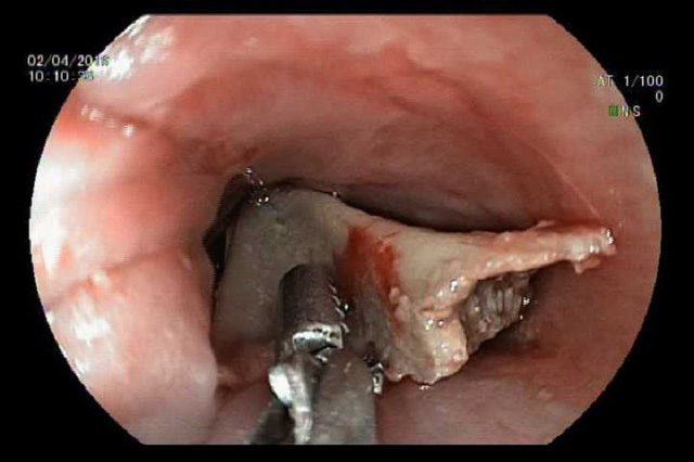 Ăn thịt g&agrave; người đ&agrave;n &ocirc;ng bị xương lọt v&agrave;o phế quản