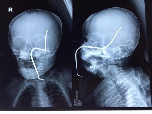 B&eacute; g&aacute;i 7 tuần tuổi bị nứt sọ v&agrave; xuất huyết n&atilde;o v&igrave; bị một quả b&oacute;ng ch&agrave;y bay tr&uacute;ng đầu