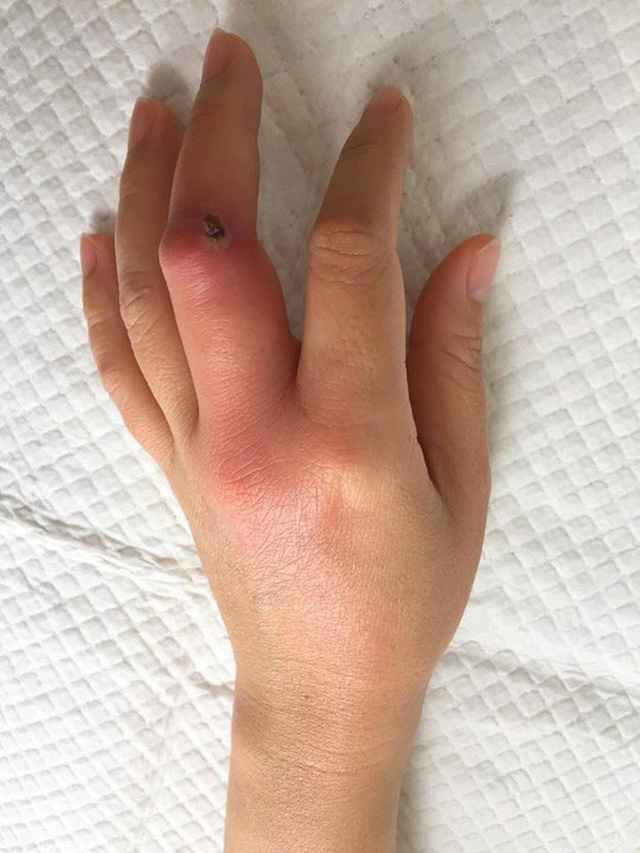 Nhiễm tr&ugrave;ng m&aacute;u: Kẻ giết người thầm lặng chỉ với một vết xước