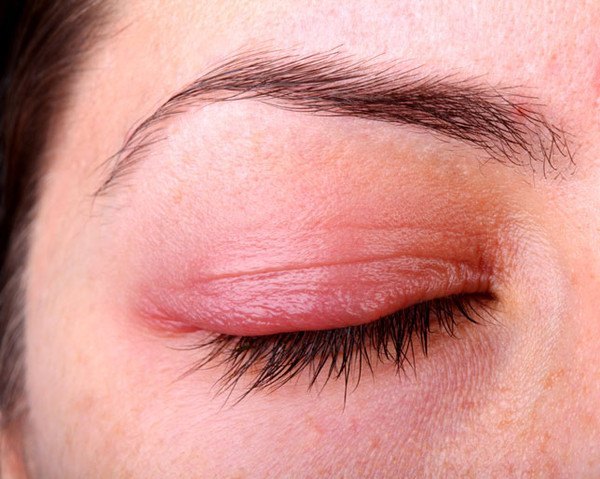 Một số căn bệnh về mắt cần ph&ograve;ng tr&aacute;nh v&agrave;o m&ugrave;a h&egrave;