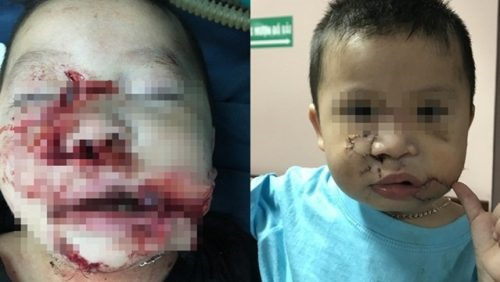 H&agrave; Nội: B&eacute; trai 2 tuổi bị ch&oacute; đẻ cắn n&aacute;t mặt, tổn thương cấu tr&uacute;c mặt nghi&ecirc;m trọng