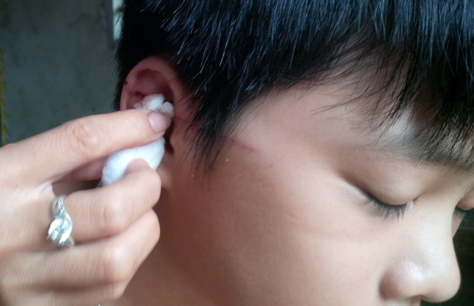 Em L&ecirc; Quang Đo&agrave;n, học sinh lớp 7A bị c&aacute;nh quạt cắt một vết d&agrave;i từ tai ra trước th&aacute;i dương (Ảnh: Tuổi trẻ)Em L&ecirc; Quang Đo&agrave;n, học sinh lớp 7A bị c&aacute;nh quạt cắt một vết d&agrave;i từ tai ra trước th&aacute;i dương (Ảnh: Tuổi trẻ)