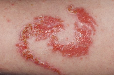 Mực xăm tạm thời c&oacute; thể g&acirc;y phồng rộp da.  
