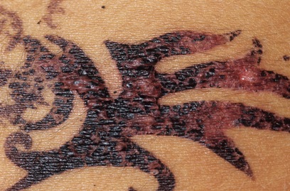  Mực xăm tạm thời, xăm henna đều c&oacute; nguy cơ g&acirc;y dị ứng da rất nguy hiểm. 