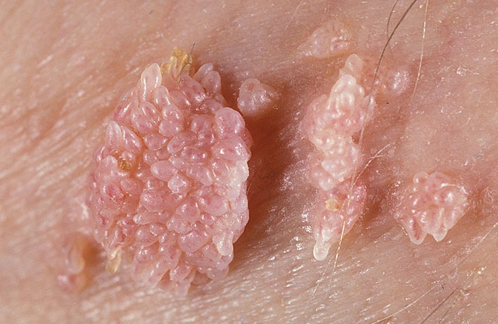 Nguy cơ ung thư cổ tử cung c&oacute; thể do một số virus HPV g&acirc;y ra