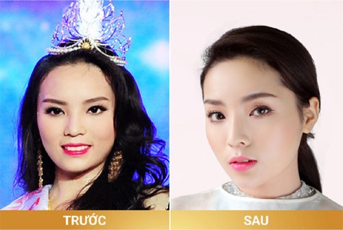 Thẩm mỹ viện bất ngờ l&ecirc;n tiếng &lsquo;vạch mặt&rsquo; Hoa hậu Kỳ Duy&ecirc;n n&oacute;i dối