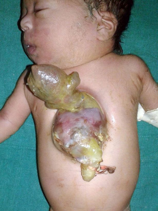 h&igrave;nh ảnh g&acirc;y sốc em b&eacute; Ấn Độ sinh ra với tr&aacute;i tim b&ecirc;n ngo&agrave;i