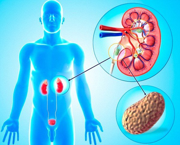 B&agrave;i thuốc d&acirc;n gian &lsquo;đ&aacute;nh tan&rsquo; sỏi thận từ quả dứa