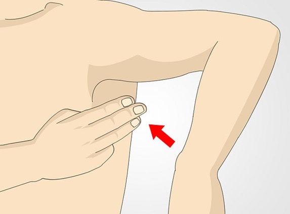 Xuất hiện hạch ở v&ugrave;ng n&aacute;ch l&agrave; một trong những dấu hiệu của bệnh ung thư v&uacute;