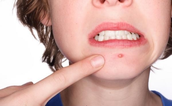 Uống qu&aacute; nhiều sữa sẽ khiến da bạn c&oacute; thể xuất hiện mụn trứng c&aacute; v&agrave; nhiều nếp nhăn ở tr&aacute;n