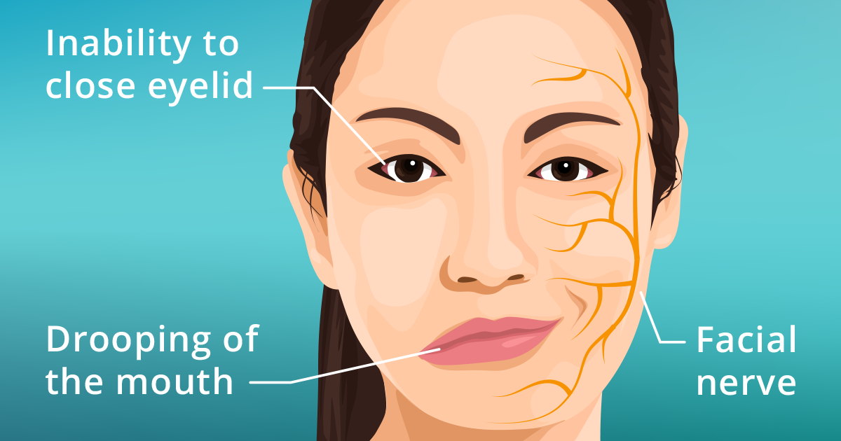 Bệnh liệt nửa cơ mặt c&oacute; một số triệu chứng li&ecirc;n quan đến mắt, tai, vị gi&aacute;c...