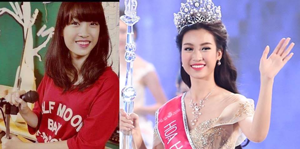 T&acirc;n Hoa hậu Việt Nam 2016 Đỗ Mỹ Linh d&iacute;nh nghi &aacute;n phẫu thuật răng h&ocirc;