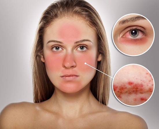 C&aacute;ch chăm s&oacute;c da nhạy cảm ai cũng cần phải biết