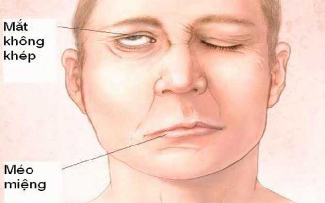 Thời tiết chuyển lạnh: Thức đ&ecirc;m nhiều cẩn thận kẻo m&eacute;o miệng, lệch mặt 