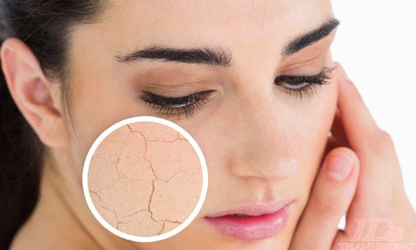 C&aacute;ch trị da kh&ocirc; nứt nẻ hiệu quả v&agrave; nhanh ch&oacute;ng nhất ngay tại nh&agrave;