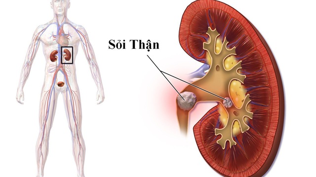 Nguy cơ sỏi thận v&igrave; 3 th&oacute;i quen hầu như ai cũng mắc phải