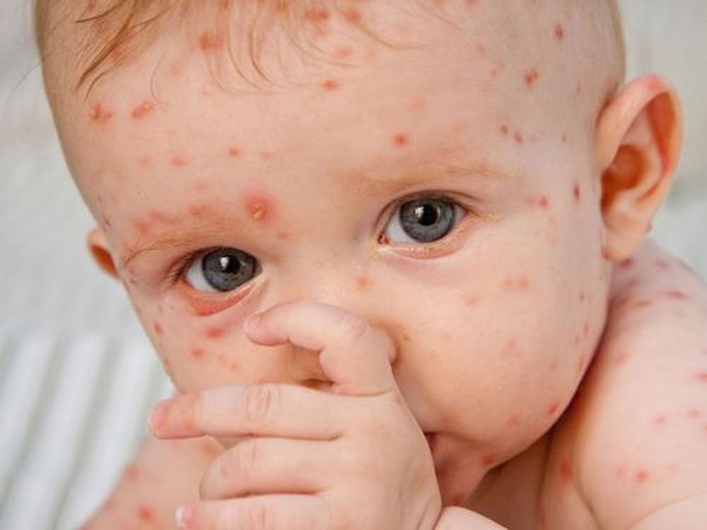 Nguy cơ b&ugrave;ng ph&aacute;t bệnh sởi tại H&agrave; Nội: Dấu hiệu nhận biết bệnh sớm nhất