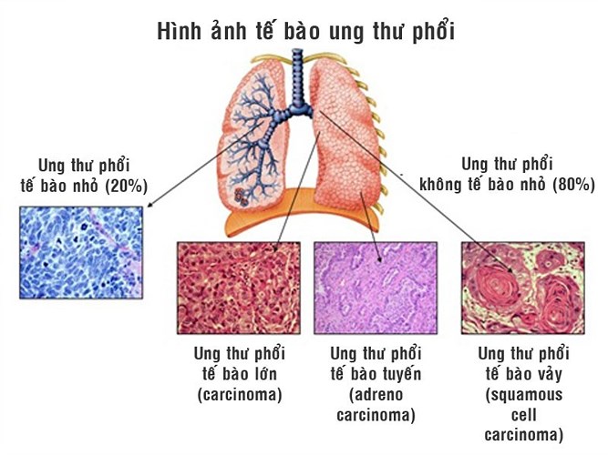 C&oacute; thể chữa được căn bệnh ung thư phổi m&agrave; diễn vi&ecirc;n Mai Phương mắc phải? 