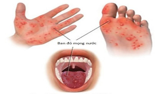 Bệnh ch&acirc;n tay miệng l&acirc;y lan ch&oacute;ng mặt: C&aacute;c dấu hiệu nhận biết sớm nhất